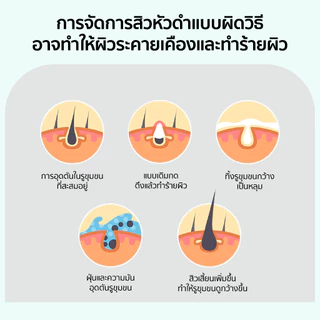 PO³ (PO Cube)มาส์กดูแลสิวเสี้ยนจมูก ช่วยทำความสะอาดรูขุมขน ผิวดูสะอาดสดชื่น