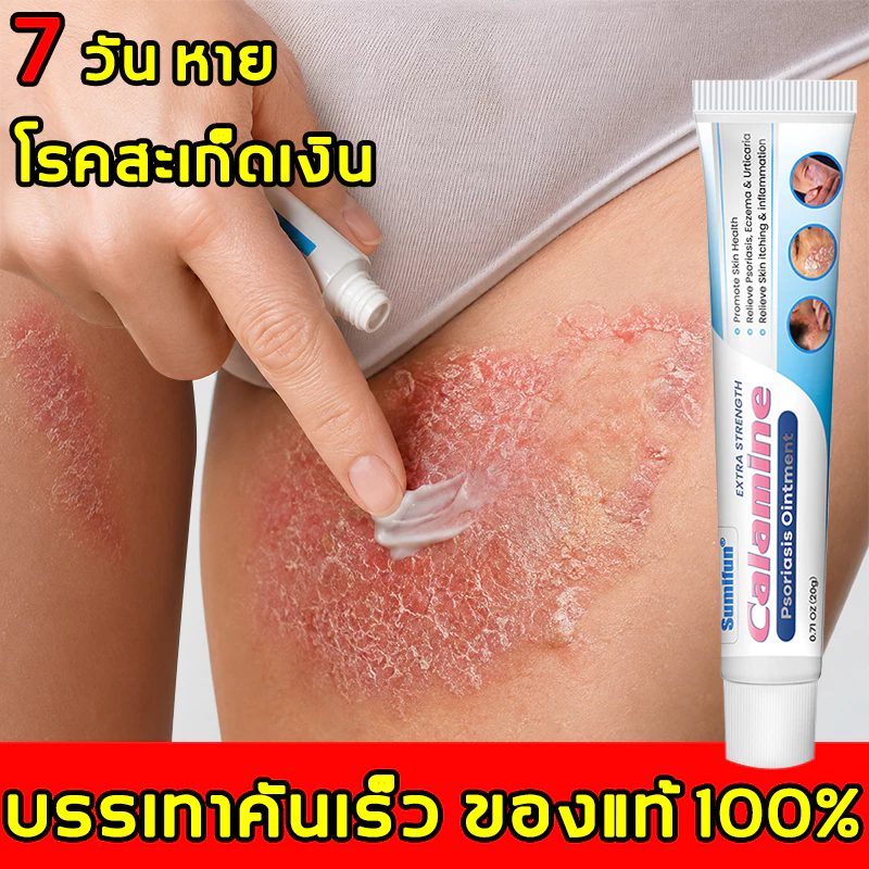 ครีมแก้คัน ครีมสะเก็ดเงิน ดูแลโรคผิวหนัง กลาก เกลื้อน อาการคัน คันเรื้อรัง และคันบริเวณจุดซ่อนเร้น