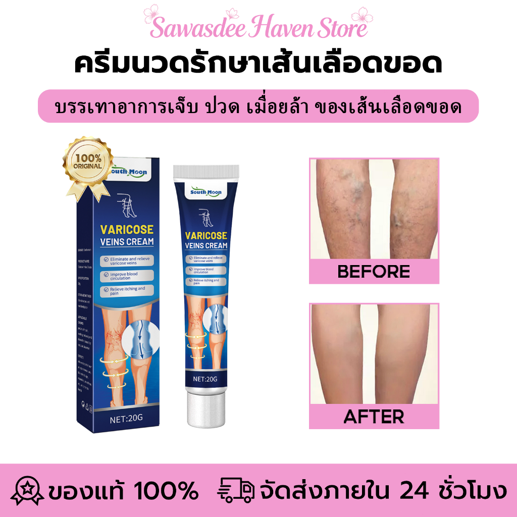South Moon ครีมรักษาเส้นเลือดขอด บรรเทาอาการเจ็บ ปวด เมื่อยล้า ของเส้นเลือดขอด Varicose Veins Cream