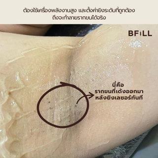 BFiLL โปรแกรม Diode Laser กำจัดขน 1 ครั้ง Size XS, S, M ขนหนวด,เครา ลดขนขึ้นไว, ตอขนชัด, ขนคุด เลเซอร์ขนบีฟิล
