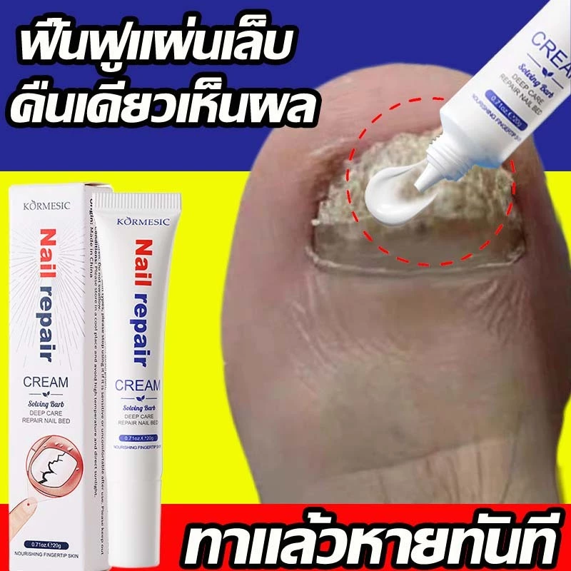 ยาทาเชื้อราที่เล็บ สำหรับดูแลเชื้อราที่เล็บ บรรเทาเล็บขบ ดูแลความสะอาดเล็บ น้ำยาบำรุงเล็บ เชื้อราที่เล็บ