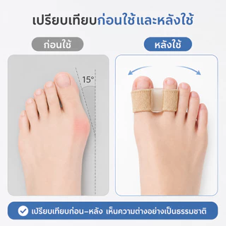 Klenik แยกนิ้วเท้า ซิลิโคน แยกนิ้วเท้า ตาปลา แยก ตาปลา Hallux Valgus แก้ไข นิ้วหัวแม่มือ แก้ไข ที่หนีบ ดูแลเท้า