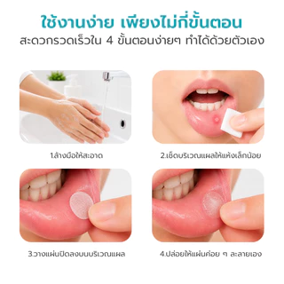 Simple Healthcare แผ่นปิดแผลในช่องปาก Time Oral Ulcer Patch รักษาแผลร้อนใน ลดความเจ็บ ไร้สารสเตียรอยด์