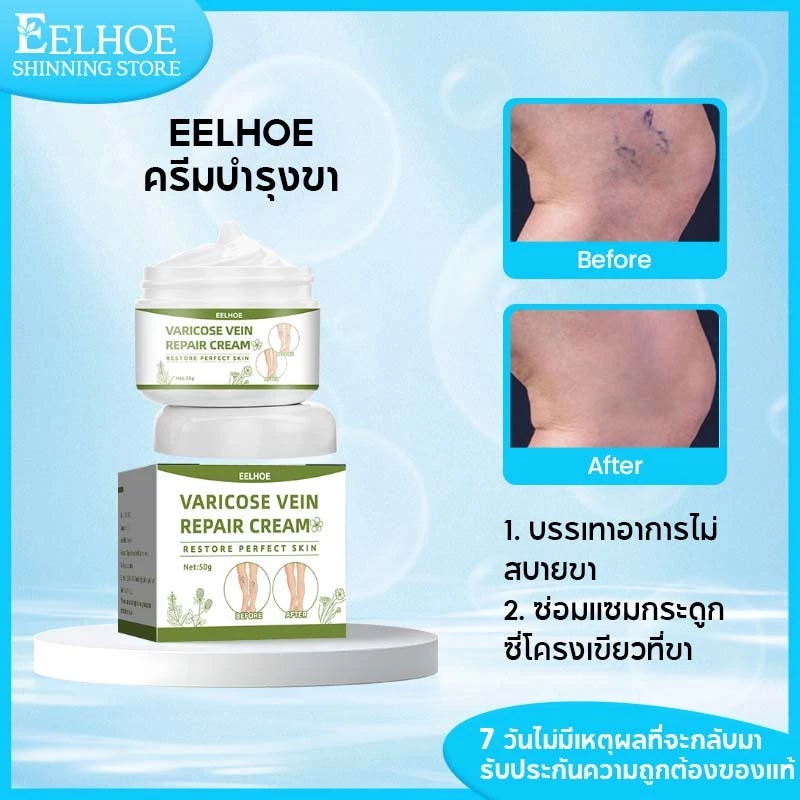 【1แถม1】EELHOE เส้นเลือดขอด ครีมทาเส้นเลือดขอด ครีม ทาเส้นเลือดขอดที่ขา ส่งเสริมการไหลเวียนโลหิต 50G