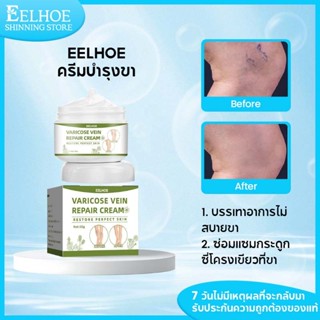 【1แถม1】EELHOE เส้นเลือดขอด ครีมทาเส้นเลือดขอด ครีม ทาเส้นเลื…