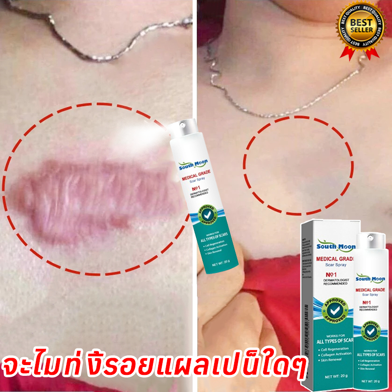 【100%ของแท้】South Moon สเปรย์ลบรอยแผลเป็น 20g เจลลดรอยแผลเป็น ครีมทาแผลเป็น แผลไฟไหม้ รอยสิว รอยแตกล