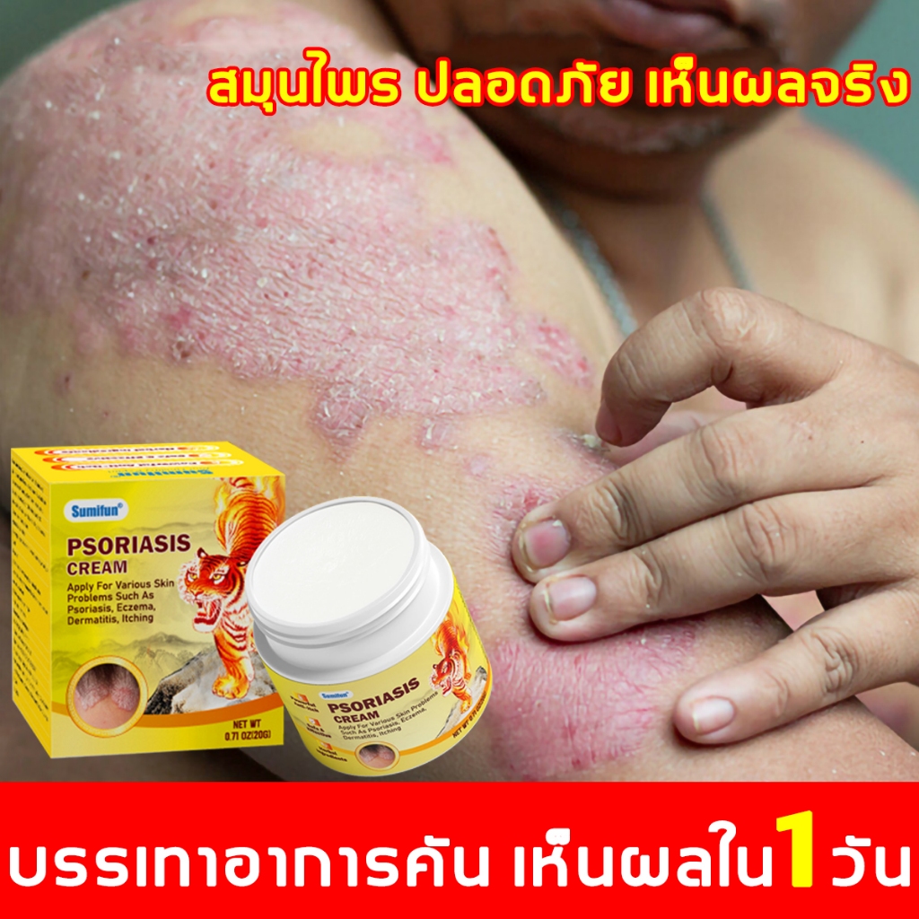 ครีมแก้คันขนาด 20 กรัม เหมาะสำหรับโรคสะเก็ดเงินและกลาก ครีมบำรุงผิวธรรมชาติแบบพกพา มีส่วนผสมของสารสกัดจากพืช ใช้ได้ทั่วร