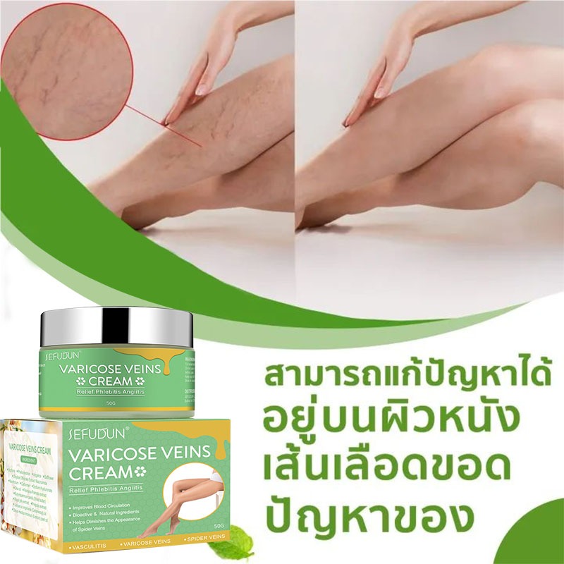 ส่งเสริมการไหลเวียนโลหิต ครีมรักษาเส้นเลือดขอด Varicose Cream ลดปวด อักเสบ ตะคริว