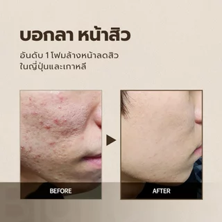 [Blanc Nature] Acne Removal Foam Cleanser โฟมล้างหน้ารักษาสิว ชาเขียวออร์แกนิก, ฮาร์ทลีฟ, ทีทรี