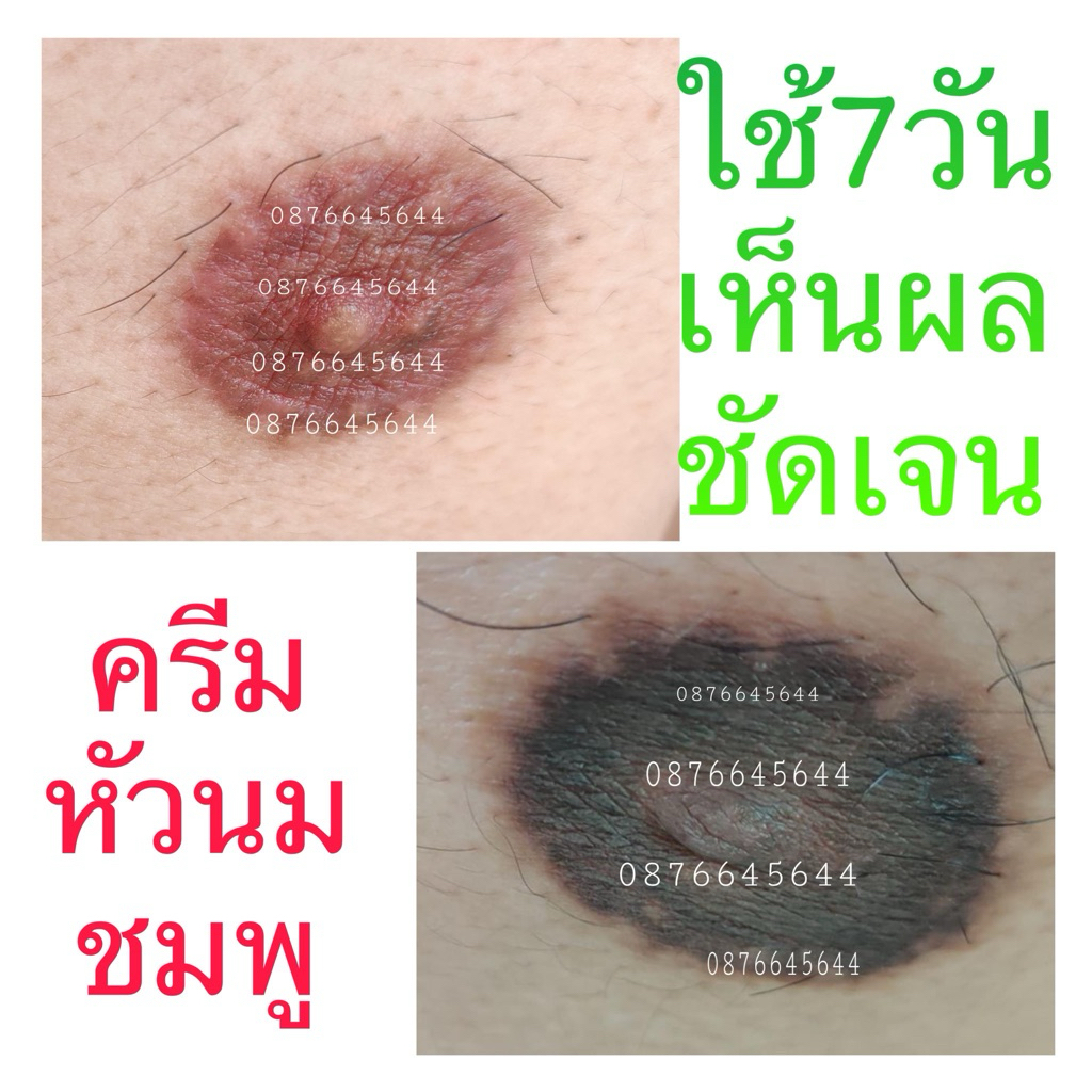 หัวนมดำแค่ไหน ก็ชมพูได้ บำรุงให้หัวนมชมพูได้ ด้วยครีมหัวนมชมพู การันตีโดยตัวแทนครีมหัวนมชมพูทุกคน