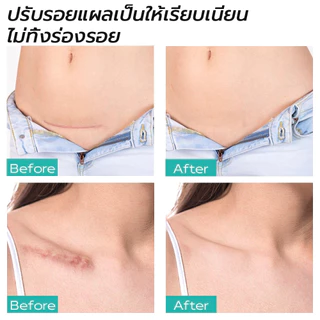 [ของแท้ 100%] ALIVER ครีมลดรอยแผลเป็น แผลเป็นนูนหนา แผลเป็นถลอก เร่งการซ่อมแซมให้ผิว ครีมแผลเป็น ลดแผลเป็น ยาทาแผลเป็น