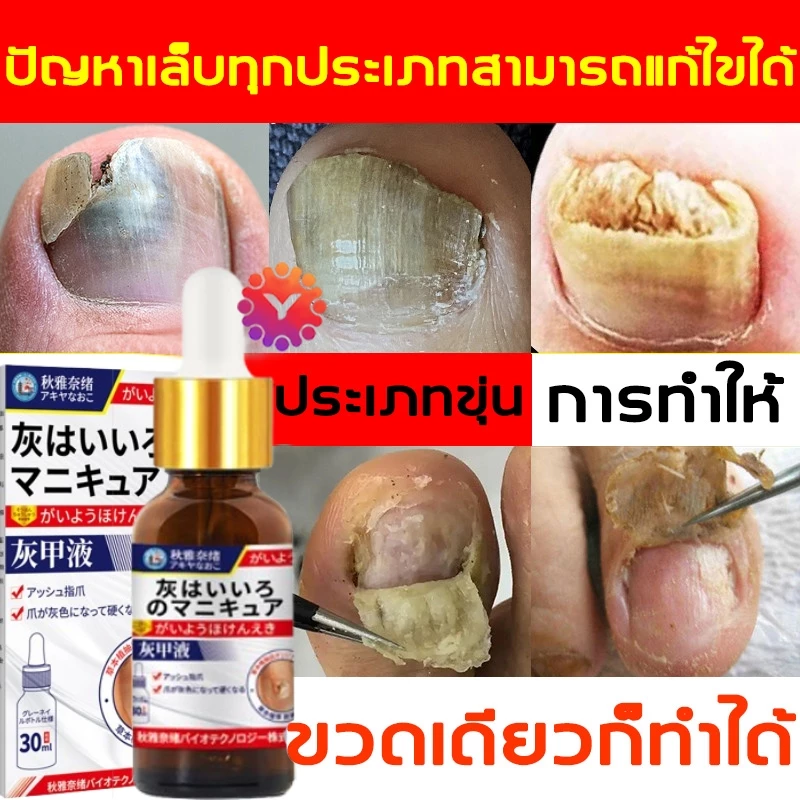 เห็นผลภายใน7วัน🔥เซรั่มบำรุงเล็บ ครีมซ่อมเล็บ ช่วยให้เล็บกลับมาแข็งแรง ครีมบำรุงเล็บ ยาเชื้อราเล็บ เซรั่มรักษาเล็บ 30ml
