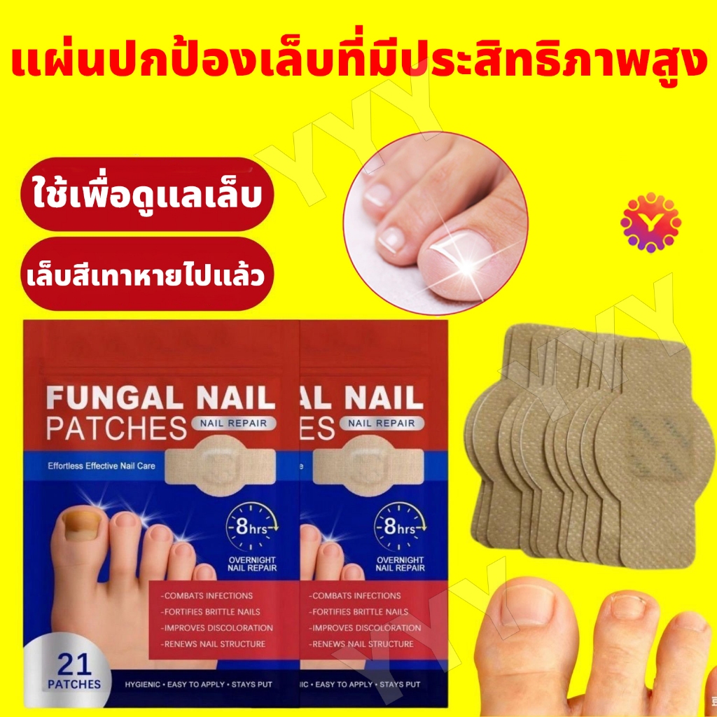 Nail Patches แผ่นแปะเล็บ เล็บขบ แผ่นแปะซ่อมแซมเล็บเท้า ซ่อมเล็บ เล็บไม่เรียบ เล็บแตก เล็บไม่แตกอีก เล็บเปราะ