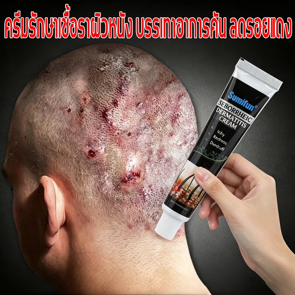 ครีมแก้คัน ครีมบำรุงผิวสูตรควบคุมความมัน ลดอาการคัน และดูแลหนังศีรษะ ให้สุขภาพดี ใช้ง่ายทุกวัน สะเก็ดเงินครีม