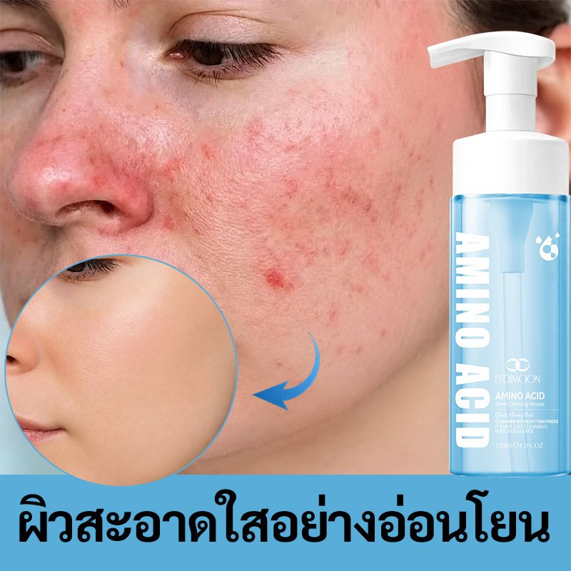 LYDIMOONโฟมล้างหน้า cleanser Acne  Foam Gentle Cleanser ลดสิว ผิวใส คุมมัน ลดสิว ชุ่มชื้น  120ml