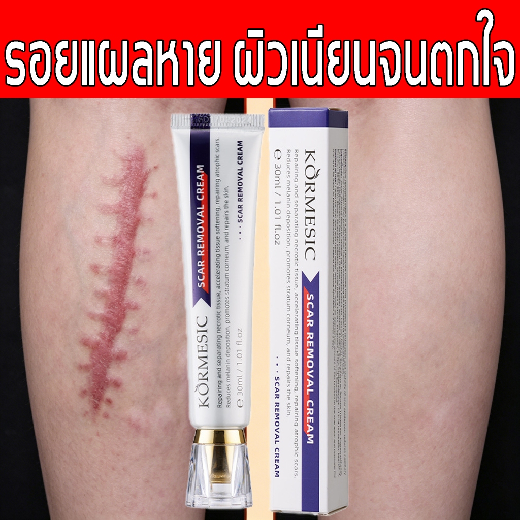 Scar Cream 30ก สำหรับรอยแผลเป็นสีดำ แผลไฟไหม้ รอยแตกลาย ทุกรอยแผลทั่วร่างกาย