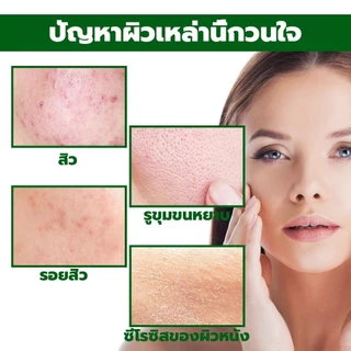เซรั่มลดสิว 30ml ครีมเจลแต้มรักษาสิว กำจัดสิว ลดรอยสิว ทำรอยสิวจางลง