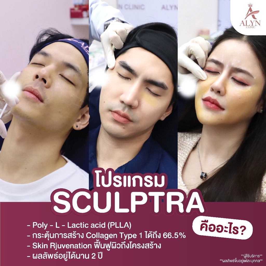 Sculptra กระตุ้นคอลลาเจน ยกกระชับใบหน้า ลดริ้วรอย ฟื้นฟูผิวแน่นกระชับ โดย Alyn Clinic