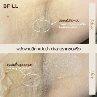 BFiLL โปรแกรม Diode Laser กำจัดขน 1 ครั้ง Size XS, S, M ขนหนวด,เครา ลดขนขึ้นไว, ตอขนชัด, ขนคุด เลเซอร์ขนบีฟิล