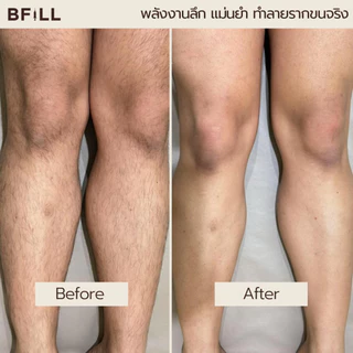 BFiLL โปรแกรม Diode Laser กำจัดขนทั้งขา ลงลึกถึงรากขน ลดปัญหาขนคุด,ขนเป็นตอ เลเซอร์ขนบีฟิล