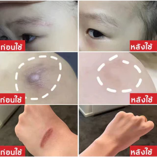 ซื้อ 2 แถม 1 ยาทาแผลเป็น เจลกู้ผิว ทาแผลเป็น ลดรอยแผลเป็น ยาลดรอยแผลเป็น ลบรอยแผลเป็น ครีมแผลเป็น น้ำร้อนลวก รอยสิว 15g