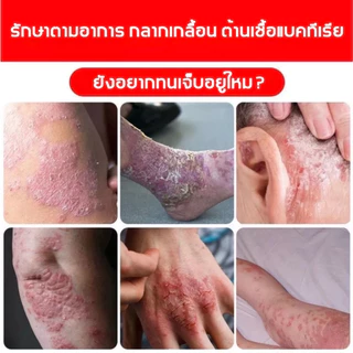 หยุดคันเร็ว ครีมแก้เชื้อรา ช่วยยับยั้งเชื้อรา บรรเทาอาการคันและผิวลอก เนื้อครีมบางเบา