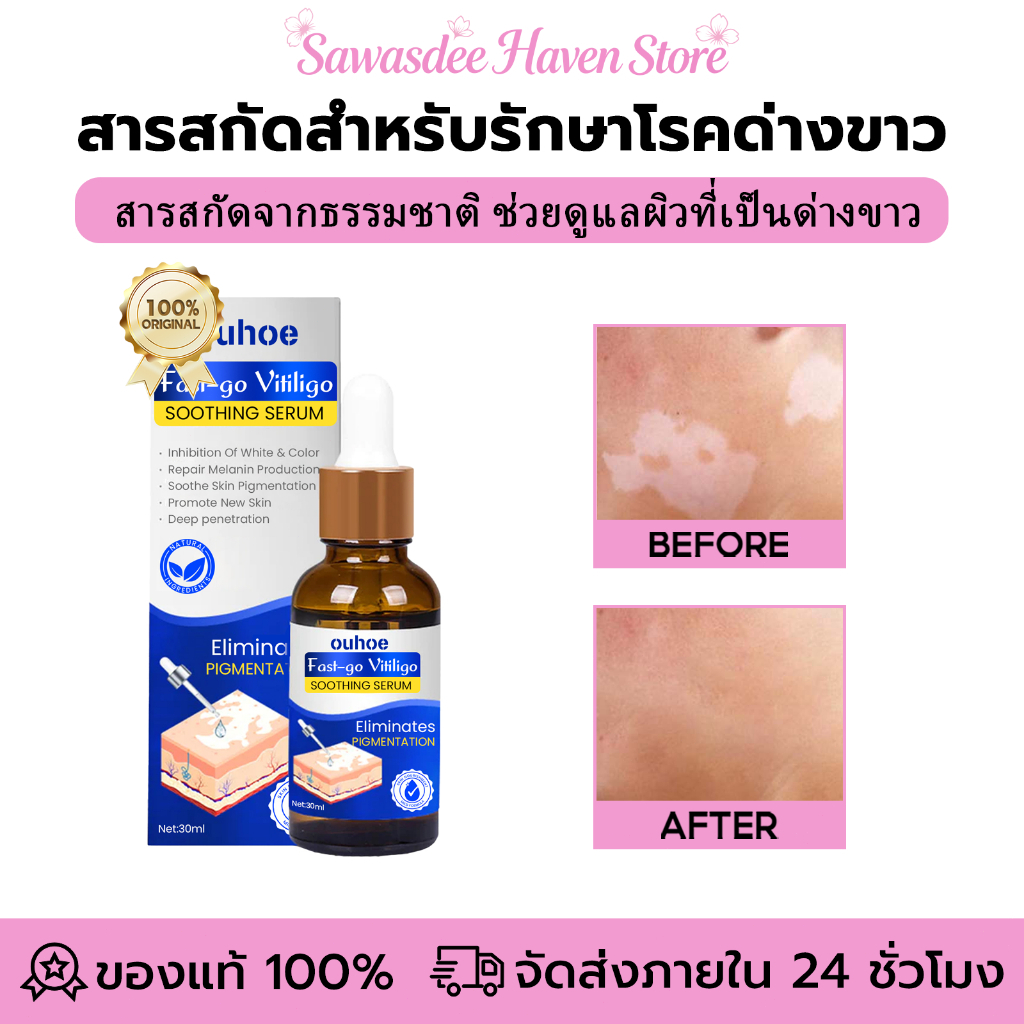 OUHOE White Spot Care Essence ครีมด่างขาว ครีมทาด่างขาว ครีมแก้ด่างขาวอย่าง แข็งแกร่ง บรรเทาต่างขาว
