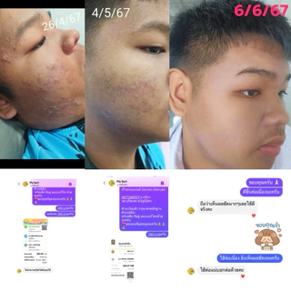 ชุดสิวหายด่วน (โฟม40g + เจลแต้มสิว) DERRATU เคลียร์ทุกสิว สิวอุดตัน สิวอักเสบ สิวยุบไว รอยสิวจางเร็ว หน้าใสไกลสิว