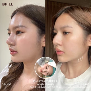 BFiLL โปรแกรม Ultraformer ยกกระชับลึกถึงชั้น SMAS, เก็บเหนียง by Doctor ไม่รวมยาชา Free Therma Lift บีฟิล คลินิก