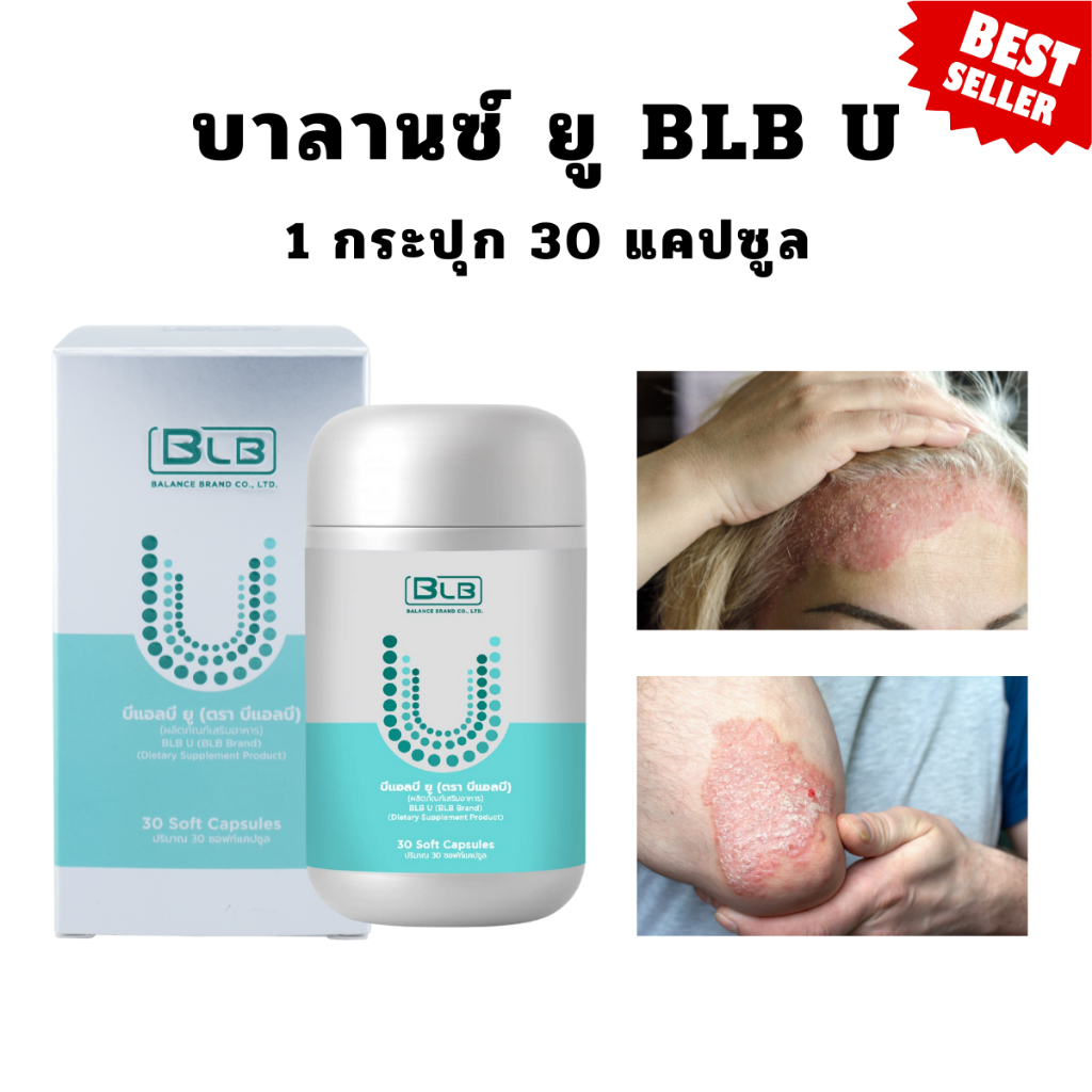 บาลานซ์ ยู ยูคอร์ ช่วยดูแลงูสวัด เริม สะเก็ดเงิน ผื่นคัน ลมพิษ  SLE บำรุงระบบประสาทและสมอง