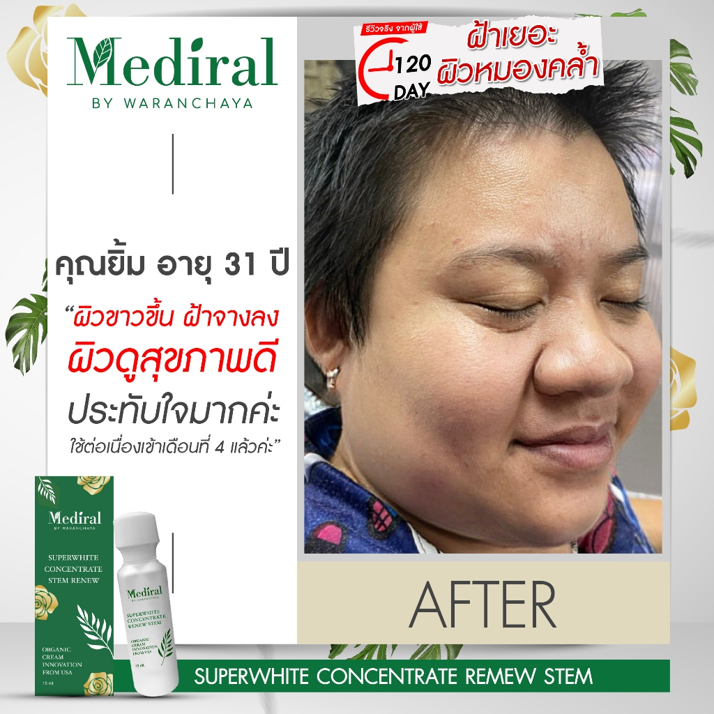 (ส่งฟรี ส่งไว!) Mediral Super White สูตรเร่งด่วน ช่วยลดฝ้า กระ รอยสิว ผิวใสขึ้นใน 7 วัน ราคา ถูกที่สุด ดีลบีเคเค แกลเลอรีภาพที่ 8