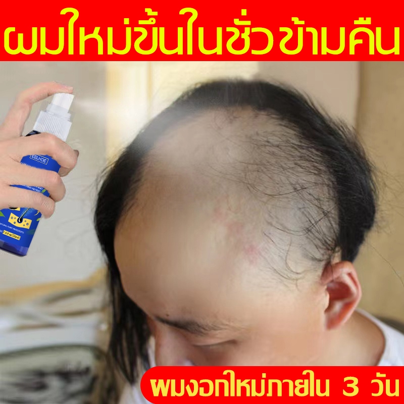 7day สเปรย์ปลูกผม ยาปลูกผมของแท้ serum ปลูกผม เร่งผมขึ้นใหม่ เร่งผมยาวไว ป้องกันผมร่วง บอกลาหัวล้าน Hair Growth Serum