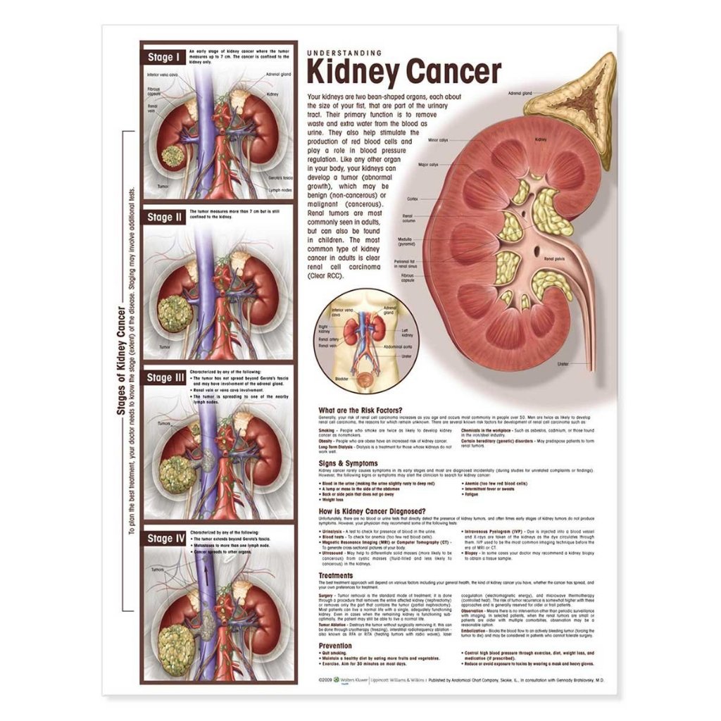 แผ่นโปสเตอร์ Understanding Kidney Cancer Anatomical Chart (Paper) ed 1/2009
