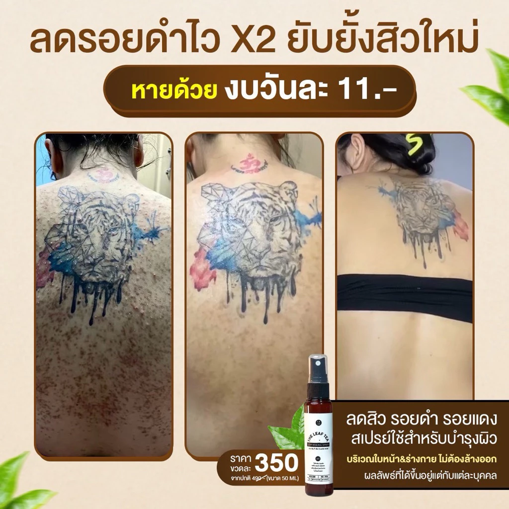 สเปรย์รักษาสิวที่หลัง สิวหน้าอก สิวใบหน้า สูตรแพทย์แผนไทย สเปรย์รักษารอยดำหลัง สเปรย์ใบชา
