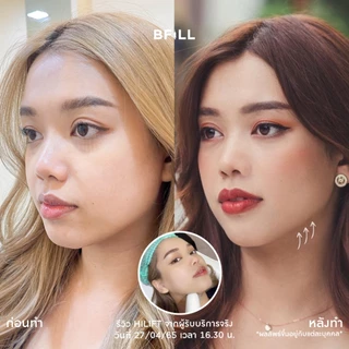 BFiLL โปรแกรม Hi Lift ไฮลิฟท์ by Specialist ลดแก้มป่อง, กรอบหน้าชัด บีฟิล คลินิก