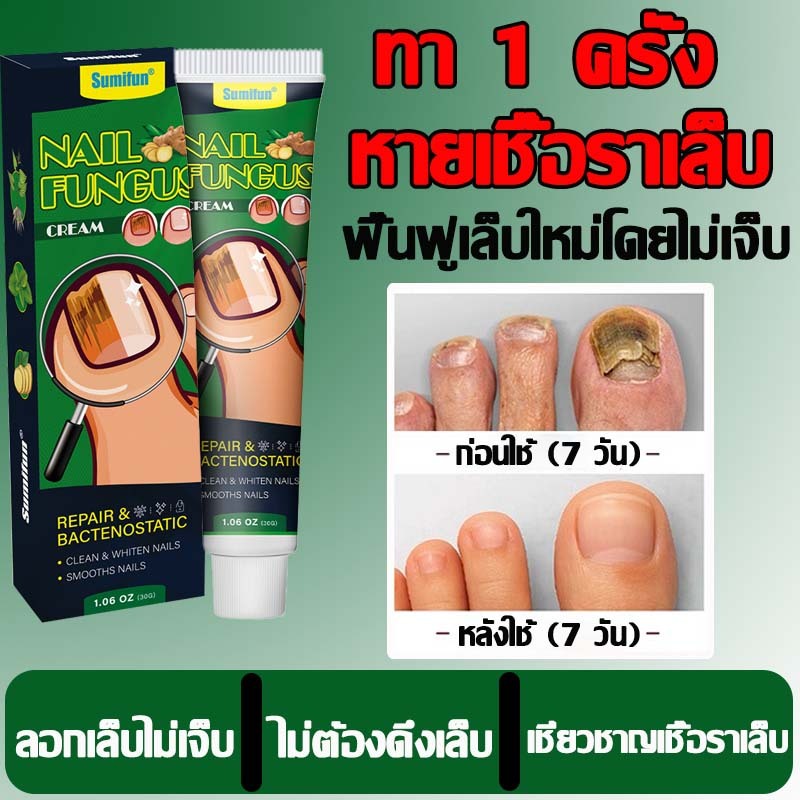 การรักษาเชื้อราที่เล็บ ต้านแบคทีเรีย การป้องกันการติดเชื้อราที่จำเป็น กำจัดเชื้อราที่เล็บ เล็บมือ เล็บเท้า เซรั่มซ่อมแซม
