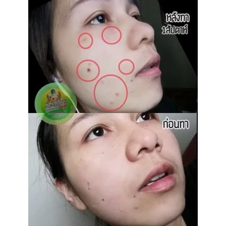ครีมกำจัดไฝ จีจี้ ของแท้100%