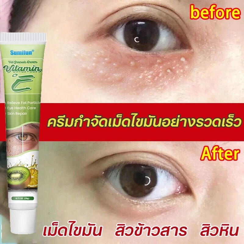 [ของแท้/ส่งไว] ครีมกำจัดเม็ดไขมัน สูตรอ่อนโยน แก้ปัญหาสิวข้าวสาร สิวหิน บำรุงรอบดวงตาอย่างเป็นธรรมชาติ (เห็นผลเมื่อใช้ต่