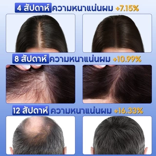 EHD แชมพูลดผมร่วง 2in1 เซ็ตคู่ 300ml+500ml ลดผมขาดหลุดร่วง คุมมัน บำรุงรากผม สำหรับคนนอนดึก หนังศีรษะมัน ผมบาง