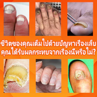 เห็นผลภายใน7วัน🔥เซรั่มบำรุงเล็บ ครีมซ่อมเล็บ ช่วยให้เล็บกลับมาแข็งแรง ครีมบำรุงเล็บ ยาเชื้อราเล็บ เซรั่มรักษาเล็บ 30ml