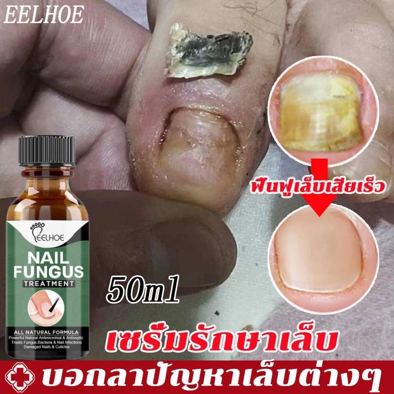 เห็นผลภายใน7วัน เอ็สเซ้นซ่อมแซมเล็บเสีย รักษารคเชื้อราที่เล็บ เล็บพัง เล็บขบ เซรั่มบำรุงเล็บ น้ำมันบำรุงเล็บ ดูแลเล็บ