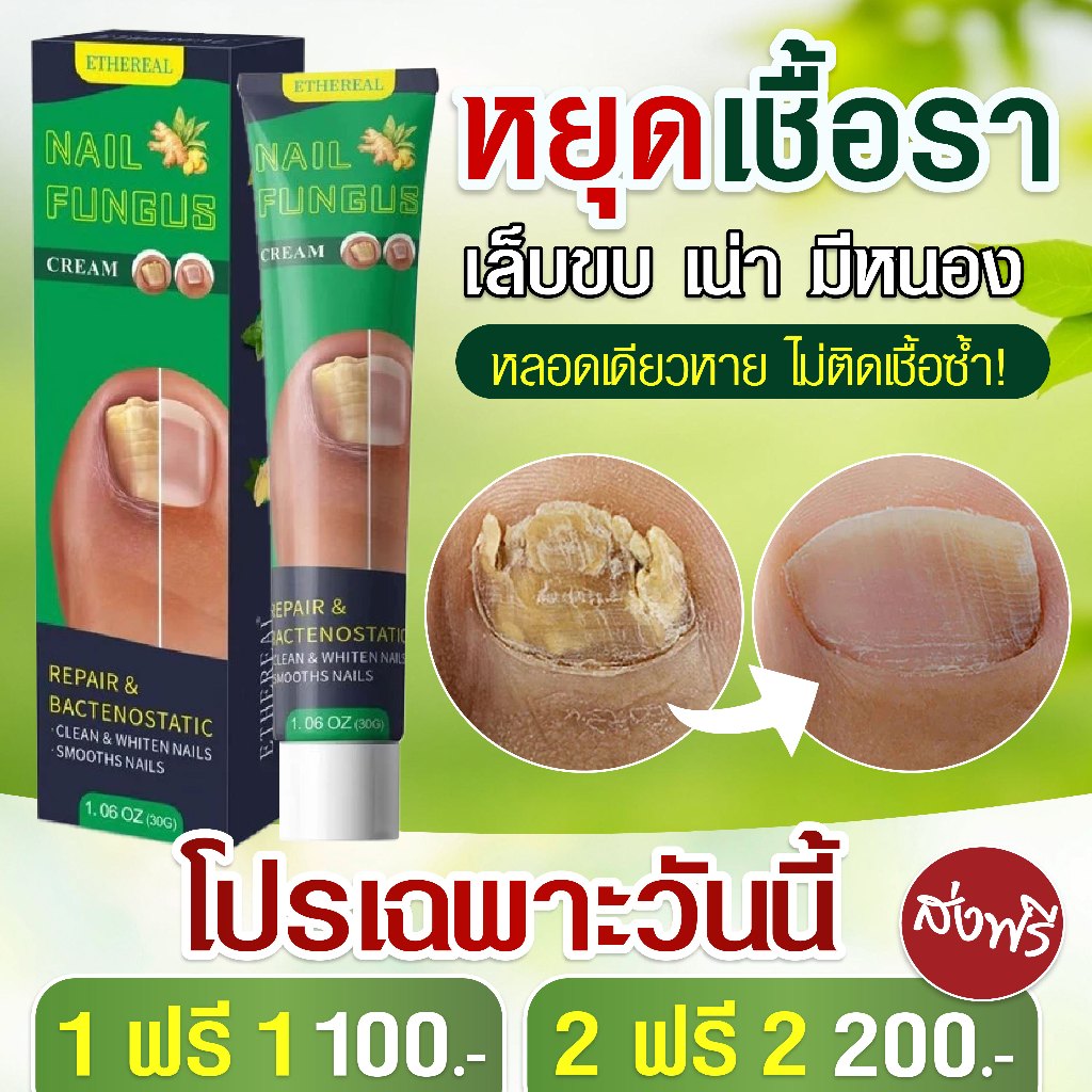 ครีมต้านเชื้อราเล็บ เล็บสวย แข็งแรง สุขภาพดี