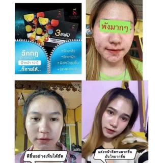 🍃✨ครีมรักษาสิว ฝ้า กระ #3สเต็ป ออร่าหน้าใส✨🍃
