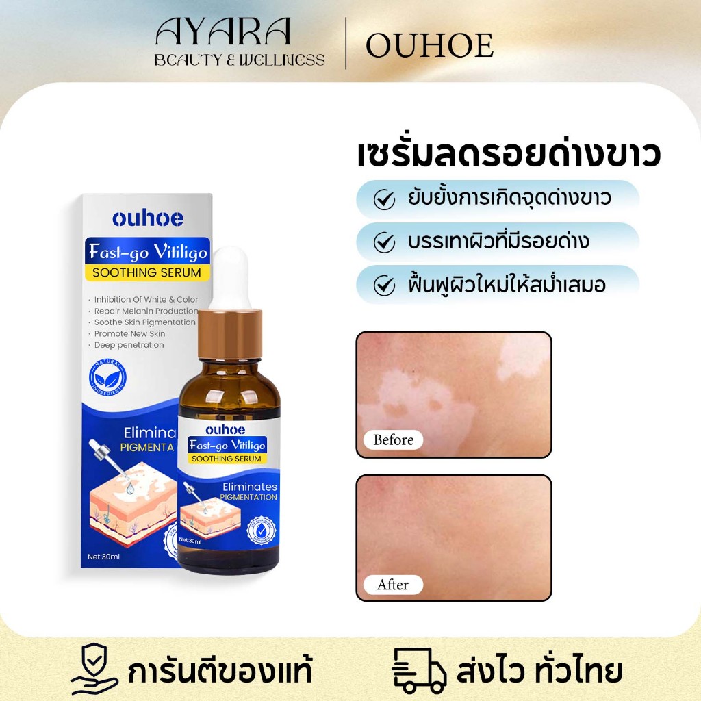 OUHOE White Spots Serum ครีมด่างขาว ครีมทาด่างขาว ครีมแก้ด่างขาวอย่าง แข็งแกร่ง บรรเทาต่างขาว ลดจุดขาว ทำให้สีผิวเท่ากัน