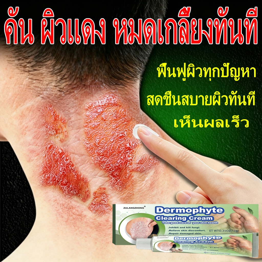 ครีมทาเกลื้อน ส่วนผสมสมุนไพรธรรมชาติ ลดอาการคัน อ่อนโยน ปลอดภัย ฟื้นฟูสุขภาพผิว ครีมทาสะเก็ดเงิน ครีมทาโรคผิว