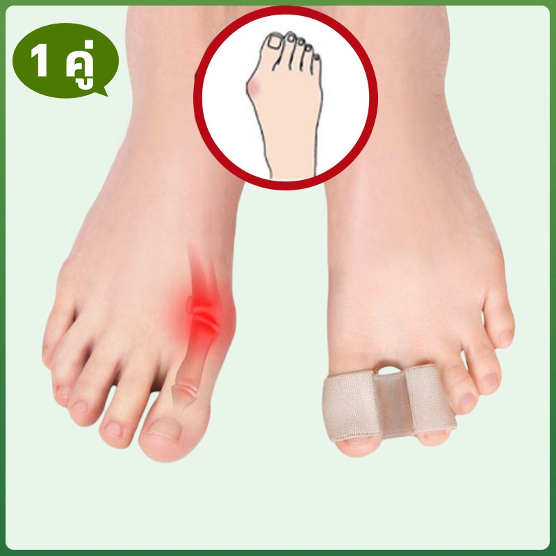 Bunion Corrector เครื่องแยกนิ้วเท้าเหมาะสําหรับการบรรเทาตาปลาและนิ้วเท้าที่ทับซ้อนกัน ใส่สบาย