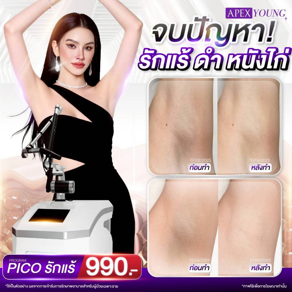 [E-Voucher] APEX Pico รักแร้ 1 ครั้ง จบปัญหา รักแร้ ดำ หนังไก่ เป็นรักแร้ขาว ใส พิเศษ 990 เท่านั้น
