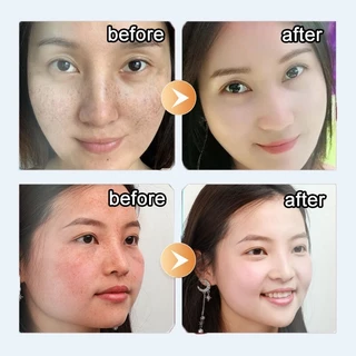 ครีมทาฝ้า 30ml ขจัดฝ้ากระ จุดดำ ผิวหน้าขาวใส