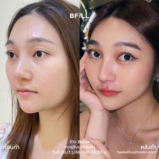 BFiLL โปรแกรม Botox Nabota โบท็อกซ์กราม ลดกราม ลิฟท์หน้า กรอบหน้าชัด ปรับรูปหน้าเรียว ออกฤทธิ์เร็ว ดื้อยาน้อย เหมา 100U