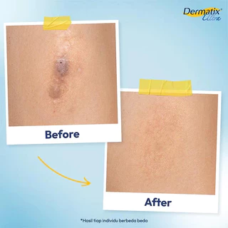 [แท้100% ส่งจากไทย] Dermatix Ultra Gel เดอร์มาติกซ์ อัลตร้า เจลลดรอยแผลเป็น ขนาด 15 กรัม ลดรอยสิว รอยผ่าตัด ผิวเนียนเรีย